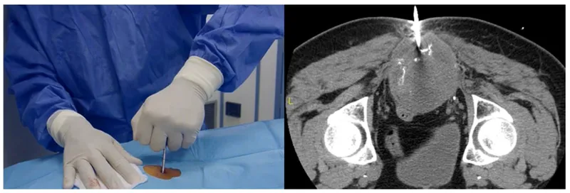 Needle biopsy procedure and CT guidance