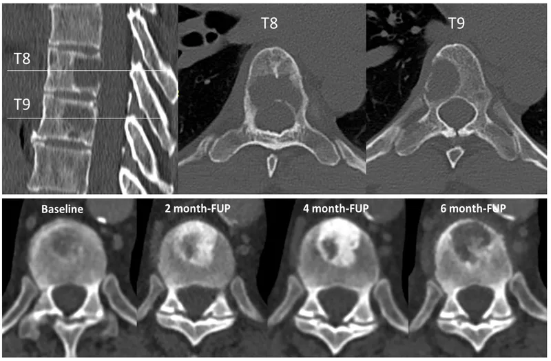 CT of metastatic bone disease in thoracic vertebrae