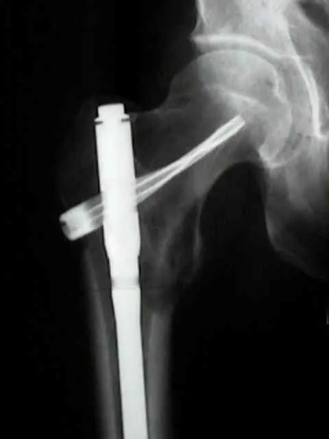 X-ray: Femur with metastatic lesion and intramedullary nail
