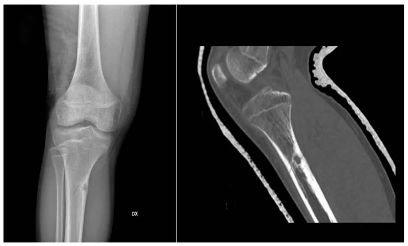 X-ray and CT of Non-Ossifying Fibroma