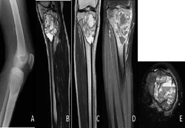 Aneurysmal Bone Cyst X-ray and MRI