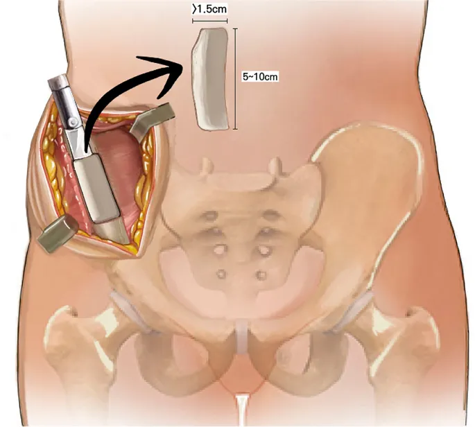 Iliac Crest Bone Graft Harvest