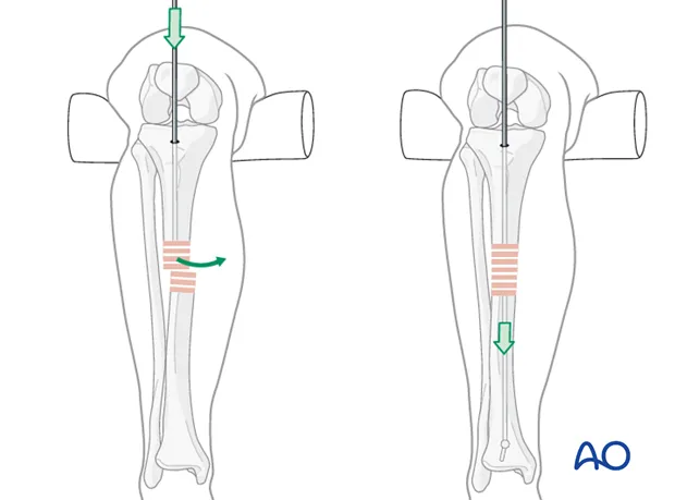 Intramedullary Nailing: Reaming and Nail Insertion