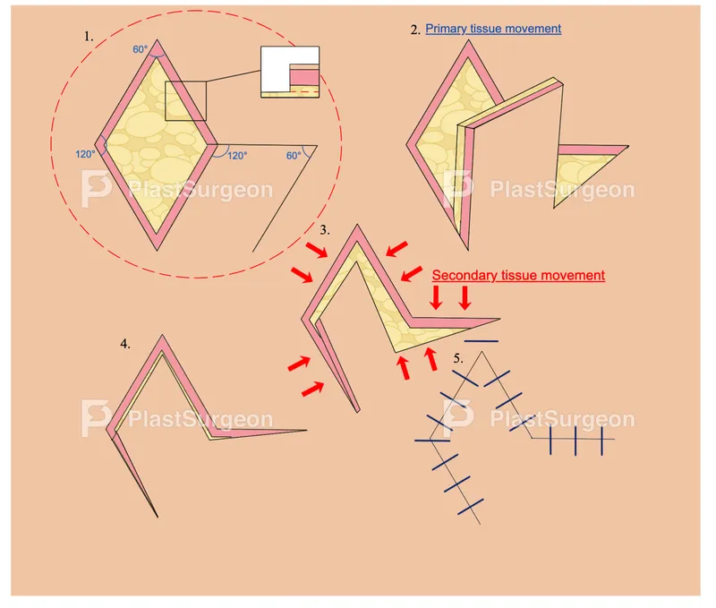 Rhomboid flap design and tissue movement