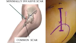 Minimally Invasive vs. Common Surgical Scars