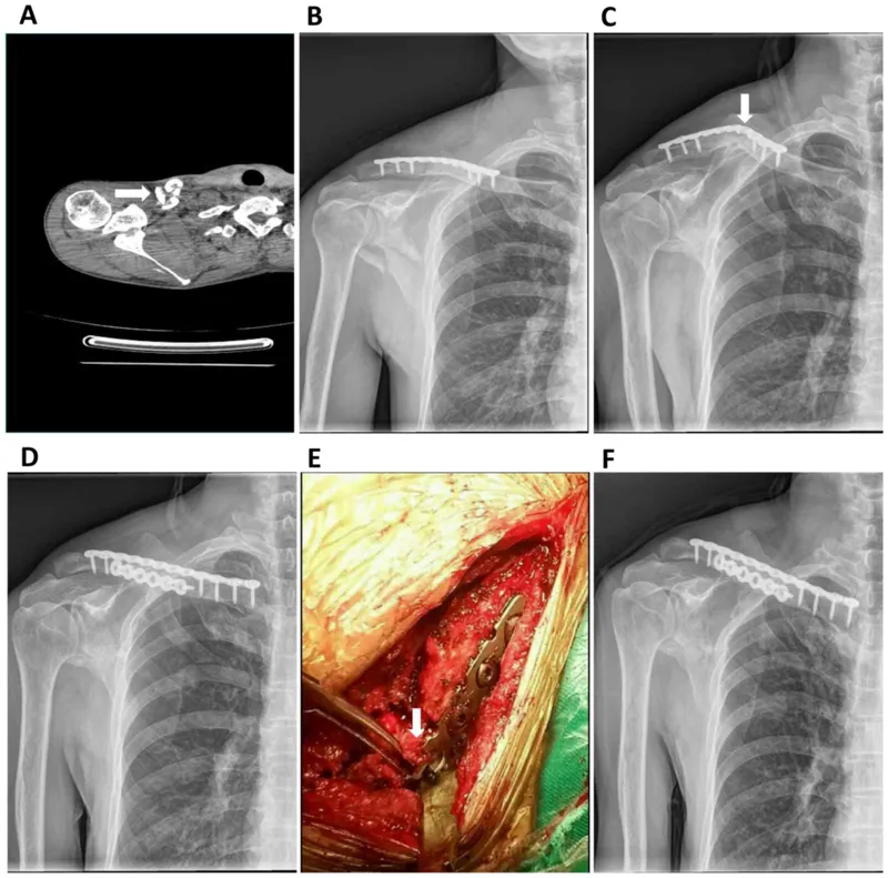Clavicle nonunion with plate breakage and screw pull-out