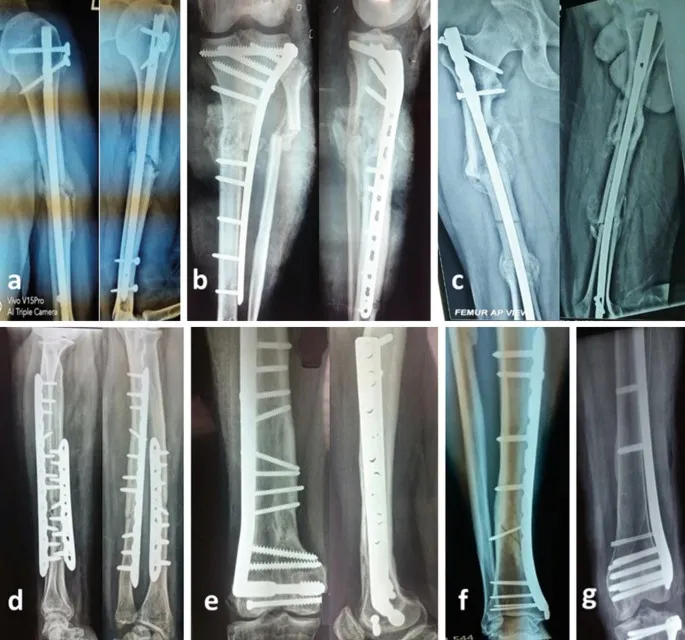 X-rays of various fracture fixations