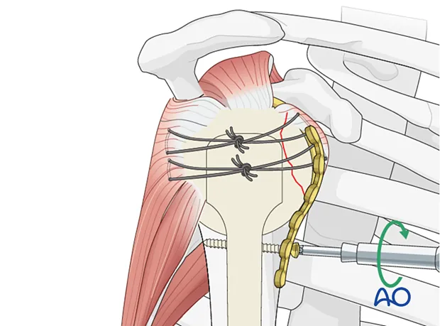 AO principles of fracture fixation