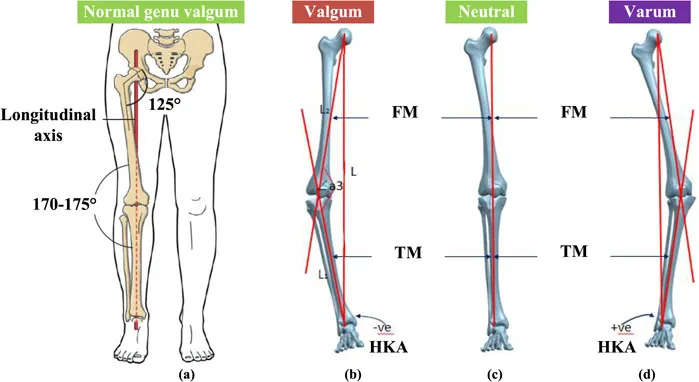 Knee alignment: normal, valgum, neutral, and varum