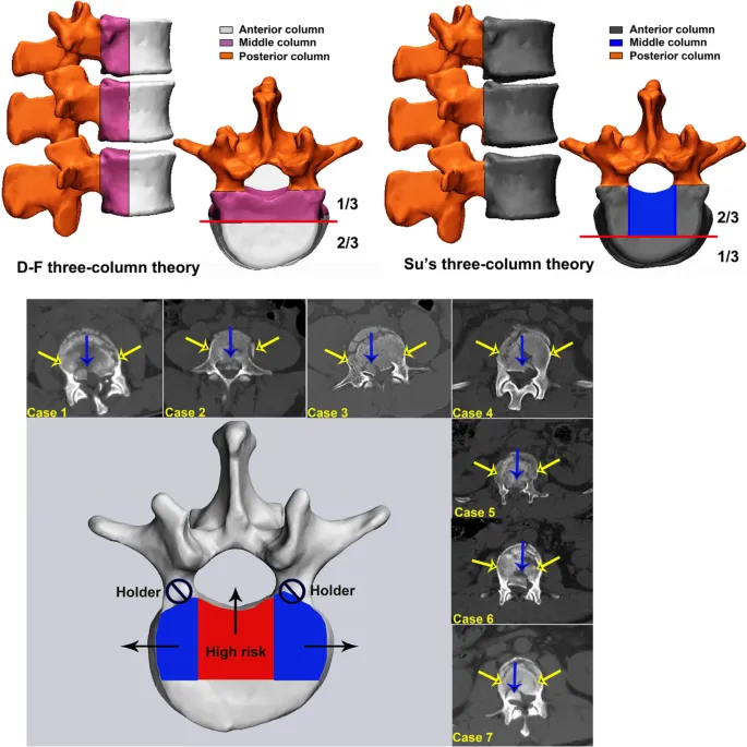 Spine three-column theories with CT cases