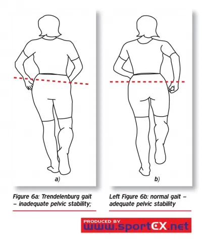 Trendelenburg vs Normal Gait: Pelvic Stability