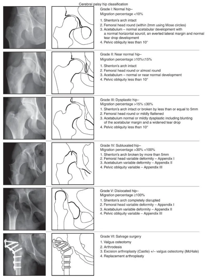 Cerebral Palsy Hip Classification and Salvage Surgery
