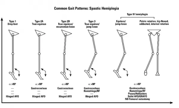Common Gait Patterns in Spastic Hemiplegia