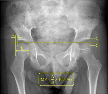 X-ray: Dysplastic Hip with Reimer's MP and Acetabular Index