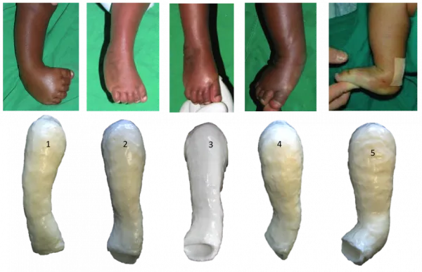 Clubfoot correction with serial casting and tenotomy