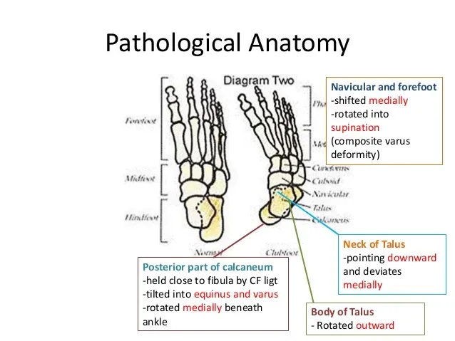 Clubfoot Pathological Anatomy Diagram