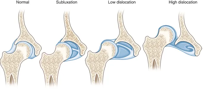 Spectrum of Developmental Dysplasia of the Hip