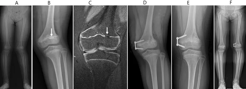 Physeal bar and guided growth treatment