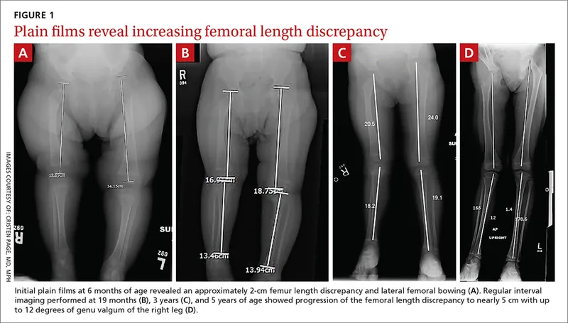 Plain films show increasing femoral length discrepancy