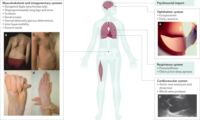 Marfan syndrome manifestations