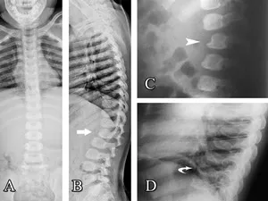 X-ray: Dysostosis multiplex