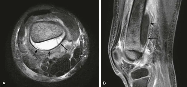 MRI of pediatric osteomyelitis of the distal femur