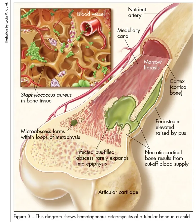 Hematogenous osteomyelitis in child tubular bone