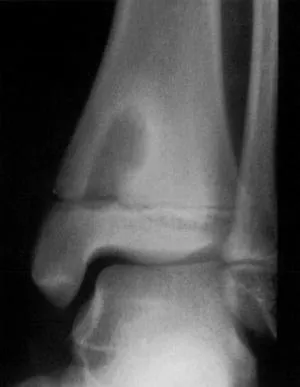 Brodie's abscess in pediatric tibia X-ray
