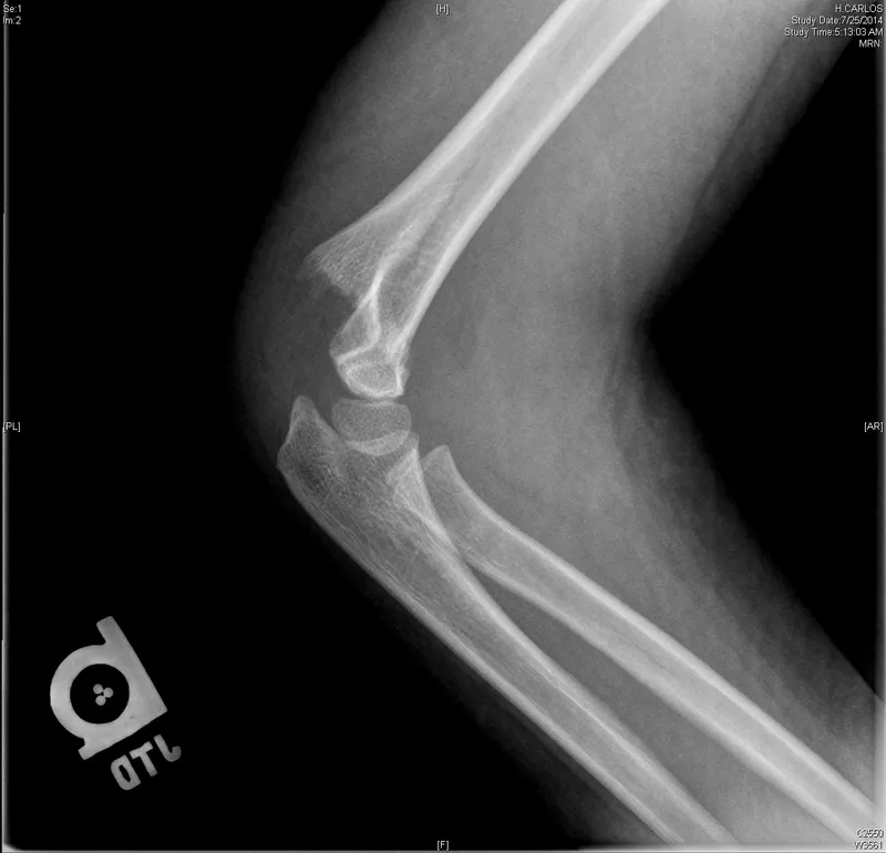 Pediatric supracondylar humerus fracture X-ray