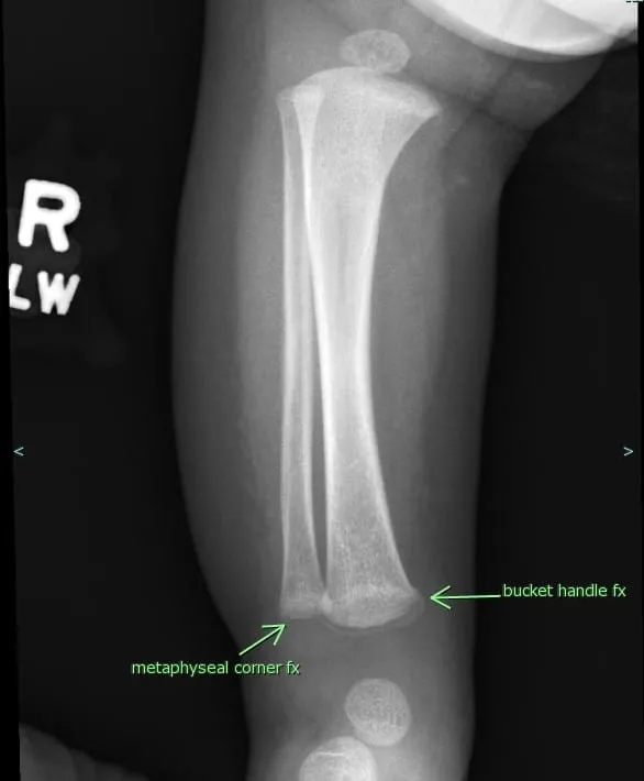 X-ray: Metaphyseal corner and bucket handle fractures