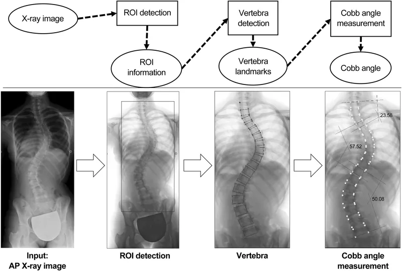 Cobb Angle Measurement Steps