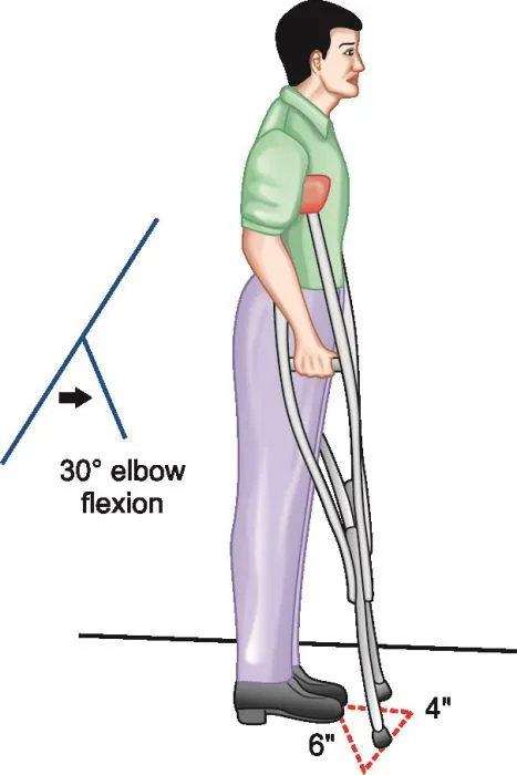 Crutch height measurement with 30-degree elbow flexion