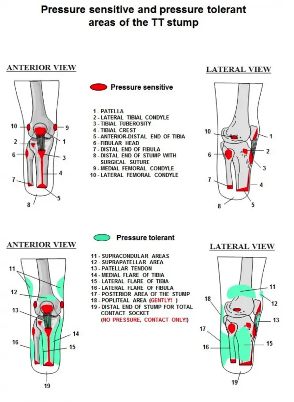 Pressure sensitive/tolerant areas of TT stump