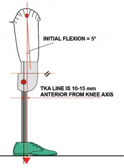 TKA line in prosthetic alignment