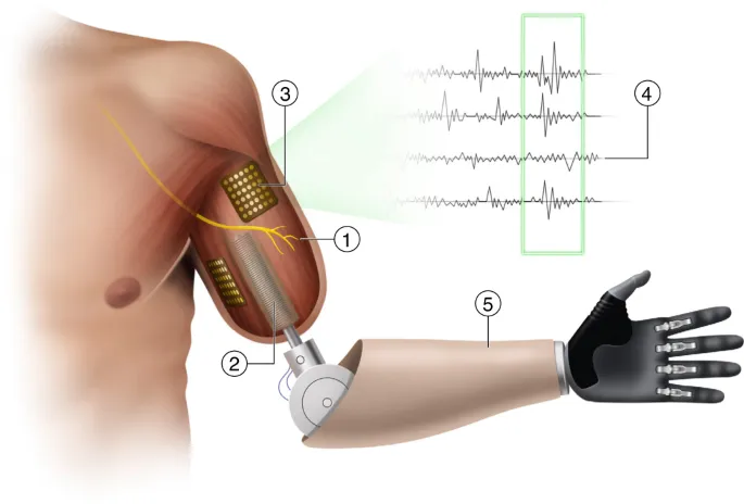 Myoelectric Prosthetic Arm Diagram