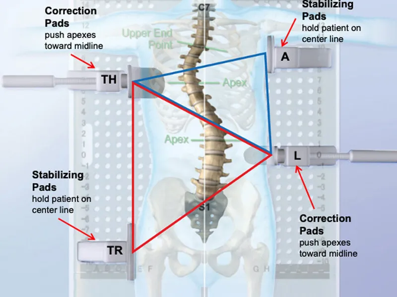 Spinal Orthosis 3-Point Pressure System