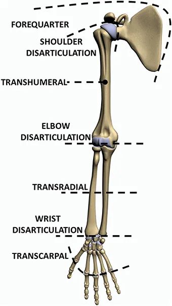 Upper Limb Amputation Levels Diagram
