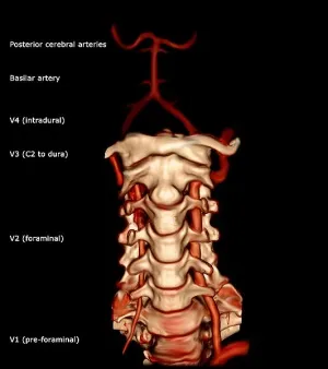 Vertebral artery segments V1-V4