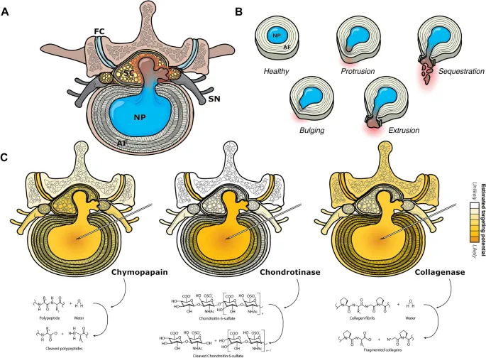 Intervertebral disc herniation types and treatments