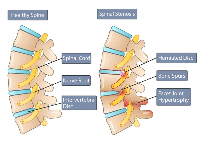Spinal Stenosis vs Healthy Spine