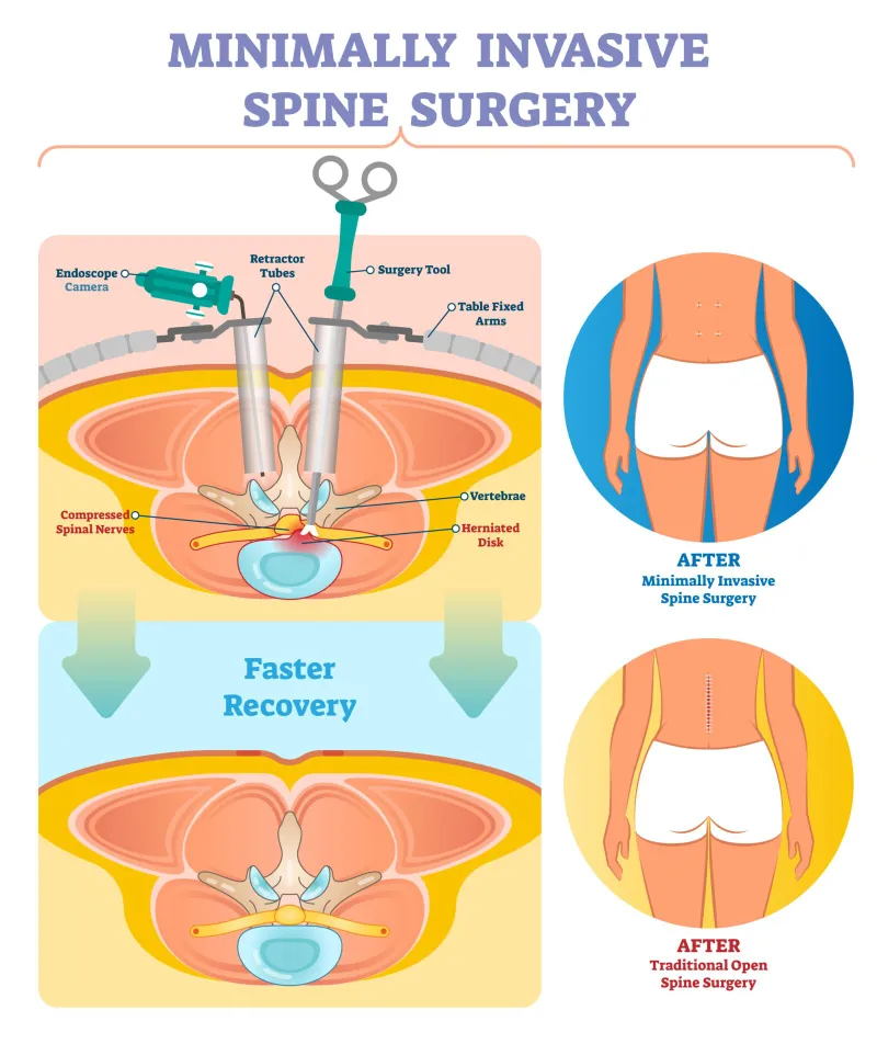 Minimally Invasive vs. Open Spine Surgery
