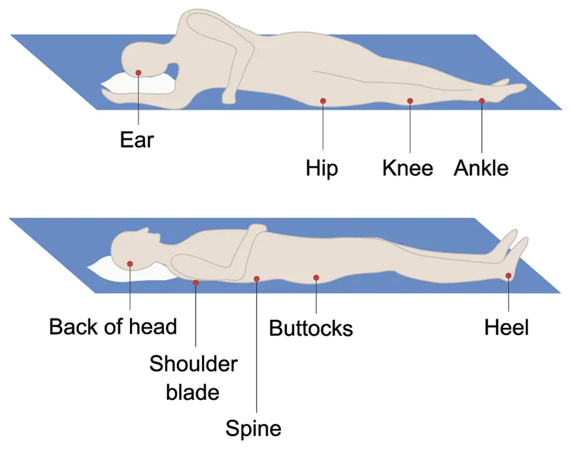 Pressure ulcer sites in supine and side-lying positions