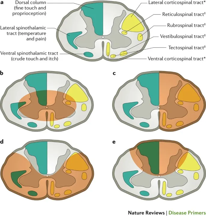 Spinal cord cross-section with tracts and injury patterns