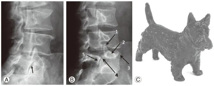 Lateral X-ray: Spondylolisthesis with Scottie dog sign