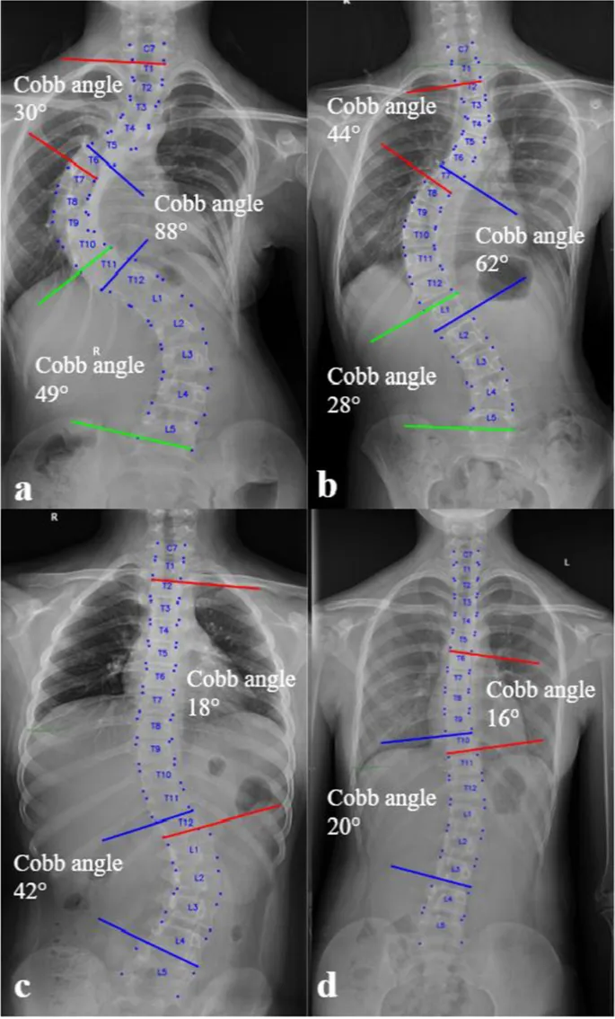 Cobb angle measurement on AP spinal X-ray for scoliosis