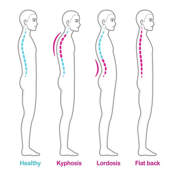Spinal Deformities: Healthy, Kyphosis, Lordosis, Flat Back