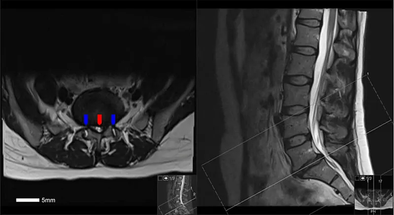 Lumbar spinal stenosis vs normal MRI