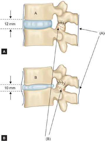 Spinal Stenosis: Normal vs. Degenerative Changes