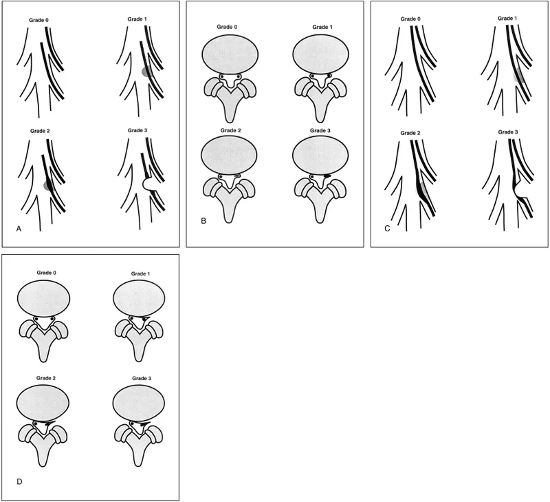 Spinal Stenosis Grading Diagrams