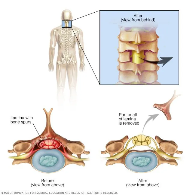 Laminectomy for Spinal Stenosis